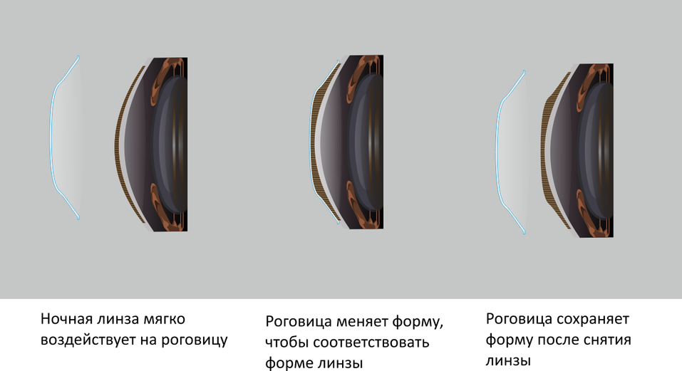 Ночные линзы плюсы и минусы